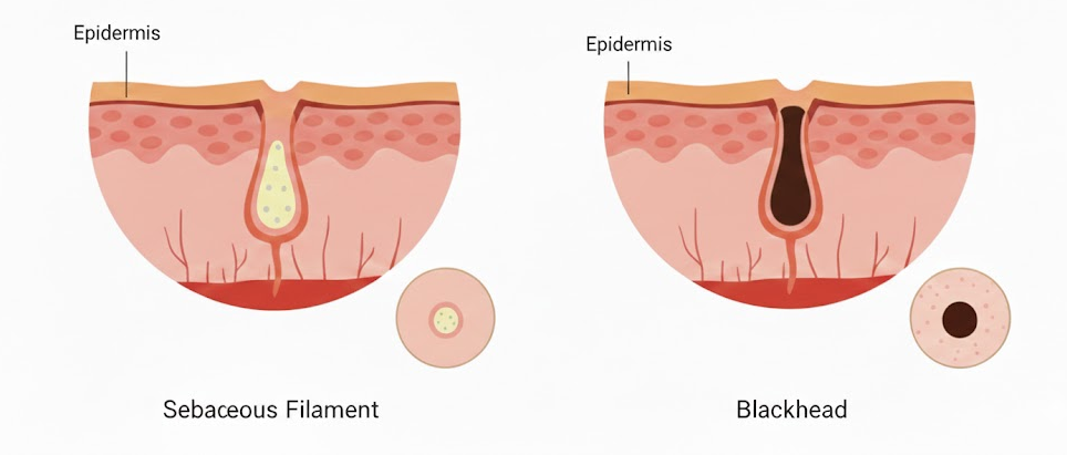 Diagram comparing sebaceous filaments and blackheads inside clogged pores