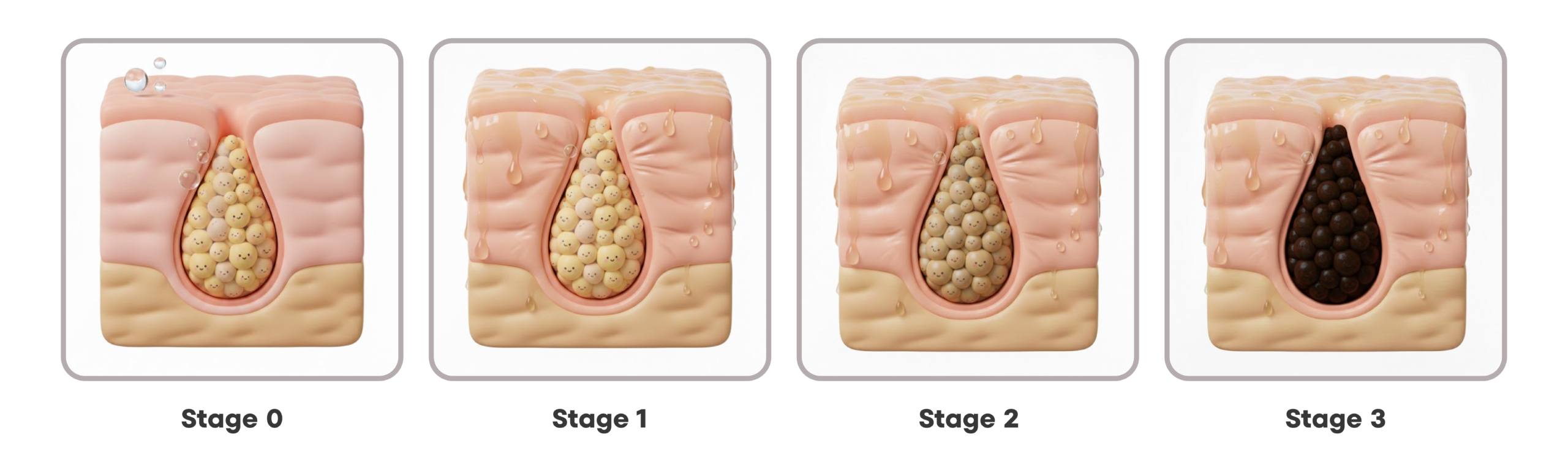 Four stages of clogged pores showing the progression from sebaceous filaments to blackheads
