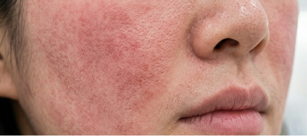 Close-up of a cheek with visible redness and irritation across the skin surface